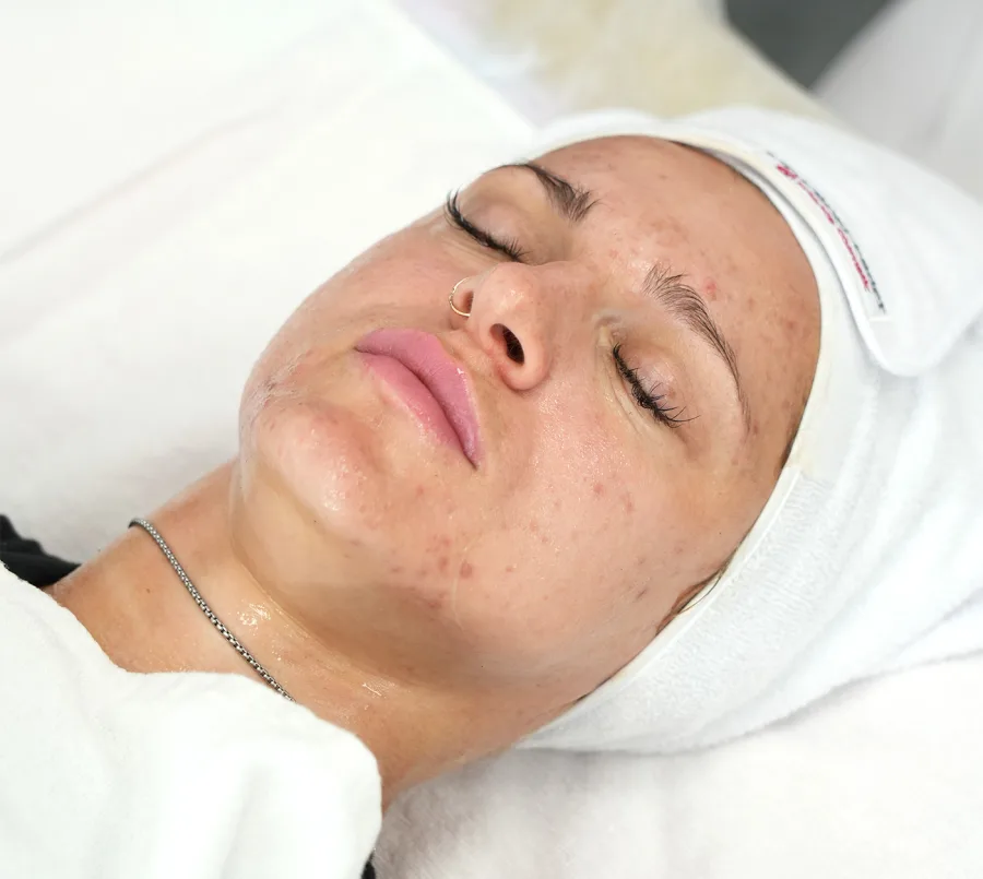 Natural skin texture before a personalized acne treatment at MIRRA BELLA