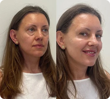 Before and after results shared by a MIRRA BELLA client